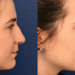 rhinoplasty in bangalore