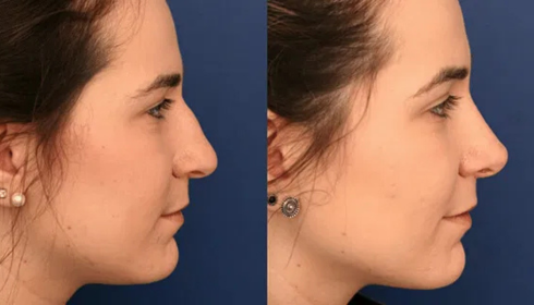 rhinoplasty in bangalore